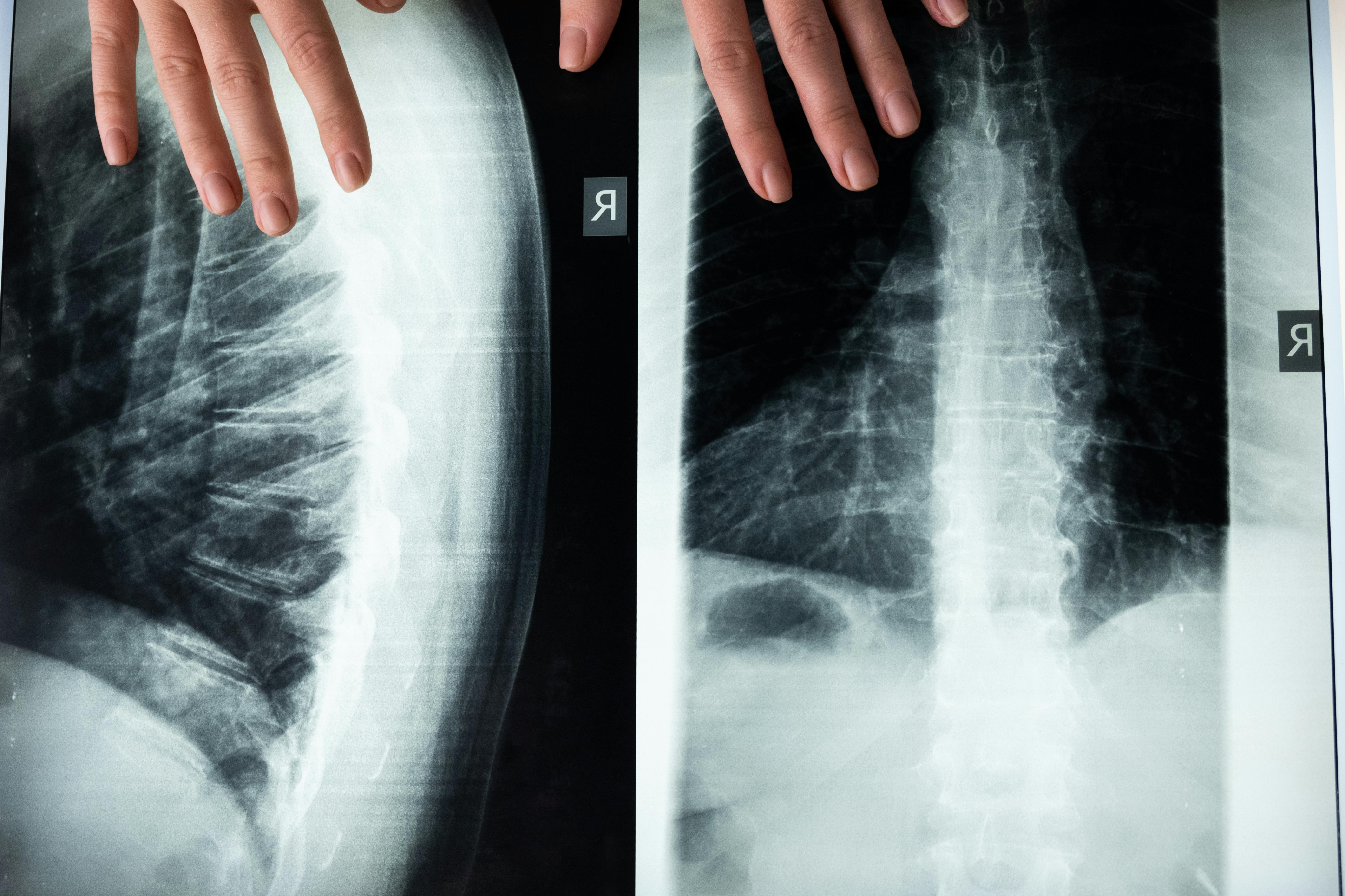 Pilates para dolor lumbar: guía responsable